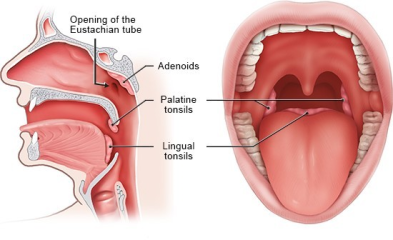 lingual tonsil stones