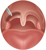 Palatal Injection for Snoring