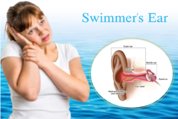 Swimmers Ear PP2110123 1