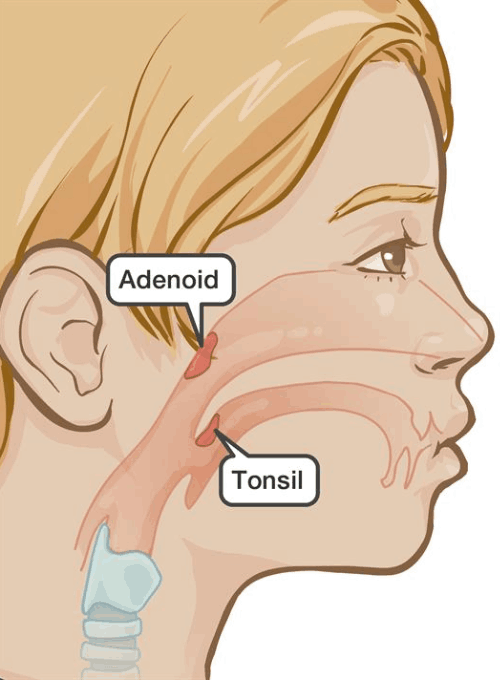 Complications of Adenoidectomy 2 1